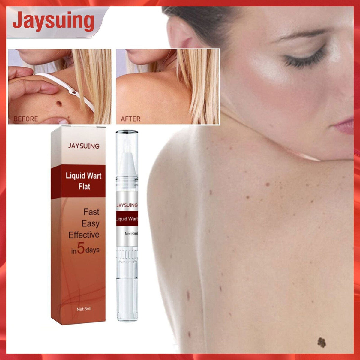 Professional Skin Tag & Mole Removal Device – Flawless Skin At Home